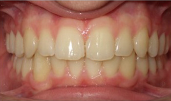 Zobovje po ortodontski obdelavi z Invisalign sistemom