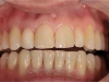 Zobovje po ortodontski obdelavi z Invisalign sistemom
